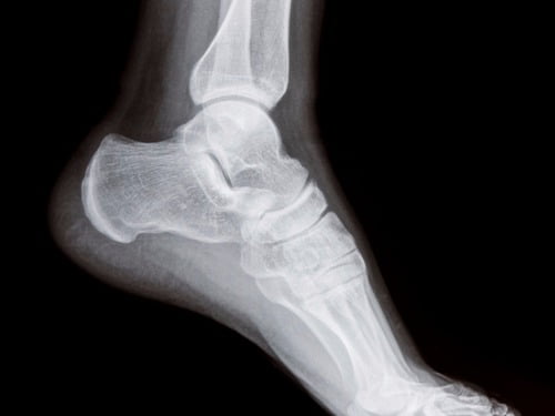 cmt foot symptoms